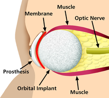 Bachelor of Science in Bio-Technology (BSc Bio -Tech)10 4 220px Prosthetic eye